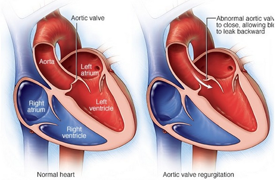 Aortic Valve Replacement Surgery in India : Cost, Hospitals & Doctor