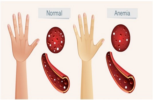 Anemia treatment in India : Cost, Hospitals & Doctor