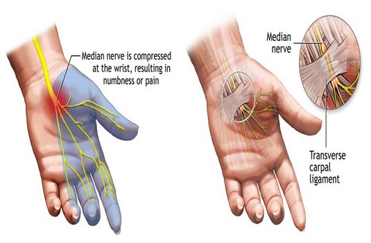 Carpal Tunnel Surgery Surgery in India : Cost, Hospitals & Doctor