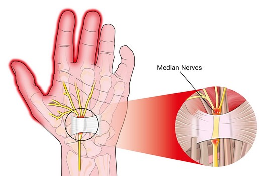 Carpal Tunnel Surgery Surgery in India : Cost, Hospitals & Doctor