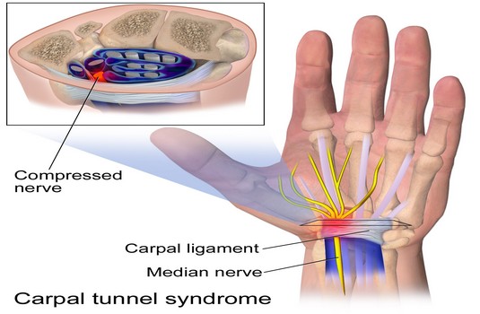 Carpal Tunnel Surgery Surgery in India : Cost, Hospitals & Doctor