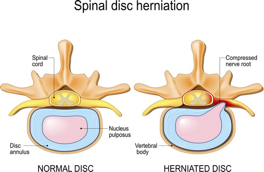 Herniated Disc - Apollo Physical Therapy Centres