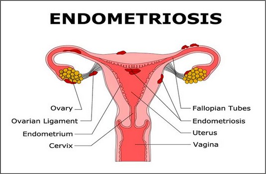 Endometriosis