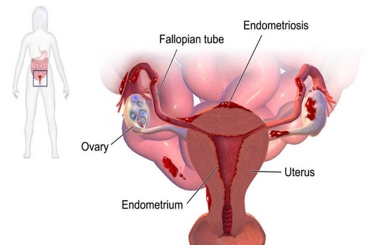 Endometriosis 1