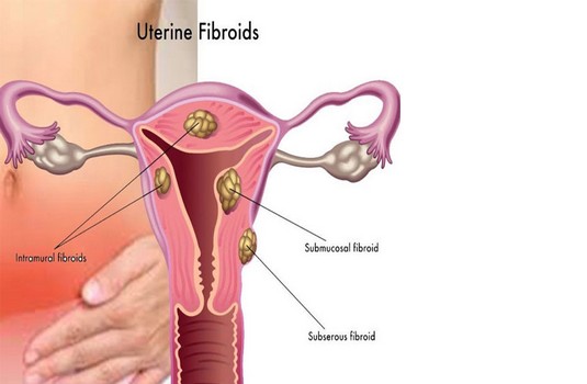  Fibroids 1