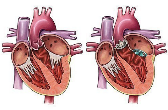 Heart Double Vavle Replacement Surgery in India : Cost, Hospitals & Doctor