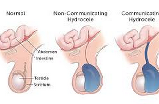 hydrocele treatment without operation