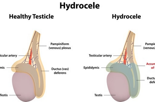 hydrocele testis treatment surgery in india cost hospitals doctor