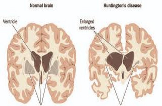 Huntington’s Disease treatment in India : Cost, Hospitals & Doctor