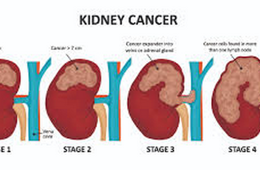 Kidney Cancer Surgery In India : Cost, Hospitals & Doctor