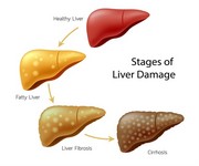 Liver Cirrhosis treatment in India : Cost, Hospitals & Doctor