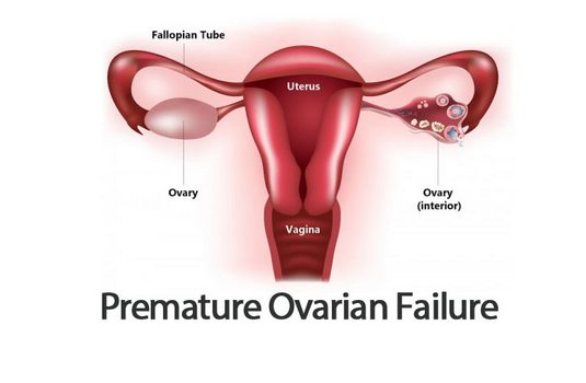 premature ovarian failure treatment