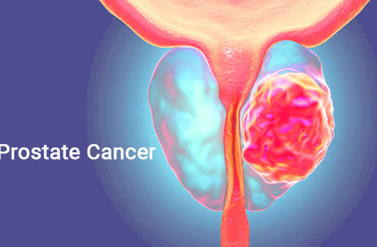 Prostate Cancer Surgery in India : Cost, Hospitals & Doctor