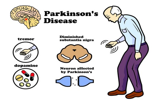 Parkinson's disease treatment in India : Cost, Hospitals & Doctor