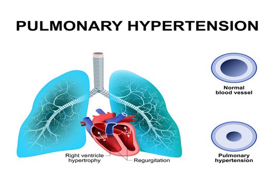 Pulmonary Hypertension treatment in India : Cost, Hospitals & Doctor