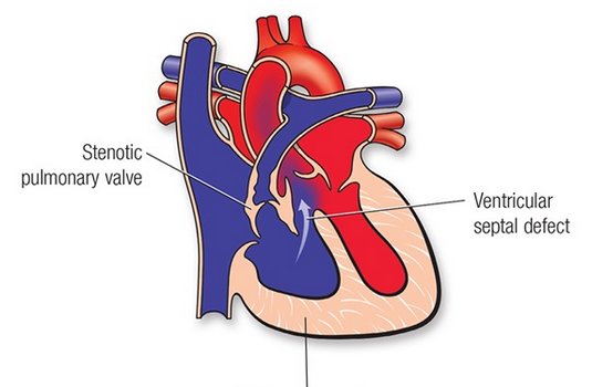 Tetralogy Of Fallot Surgery in India : Cost, Hospitals & Doctor