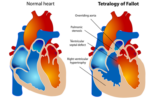 Tetralogy Of Fallot Surgery in India : Cost, Hospitals & Doctor