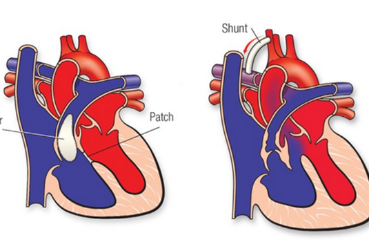 Tetralogy Of Fallot Surgery in India : Cost, Hospitals & Doctor