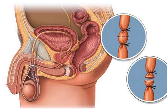 Vasectomy Surgery In India Cost Hospitals Doctor