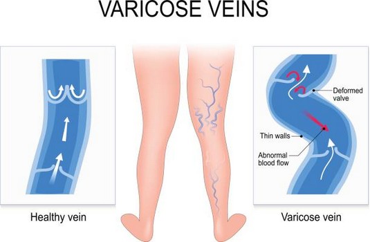 Varicose Veins Treatment in India : Cost, Hospitals & Doctor