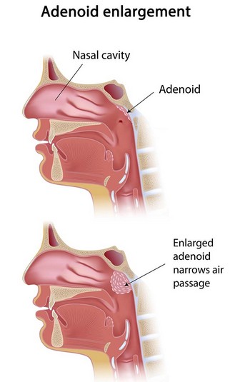 Adenoidectomy Surgery in India : Cost, Hospitals & Doctor