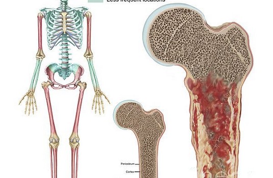 Soft Tissue And Bone Sarcomas And Bone Metastases Treatment in India